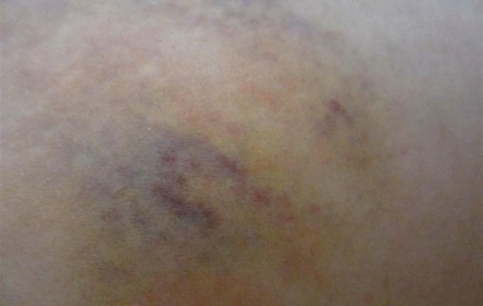 2012-2-18_bmx_bruise
